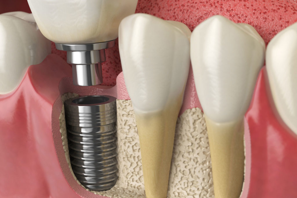 Dental Implant Lexington Lexington Park, Maryland